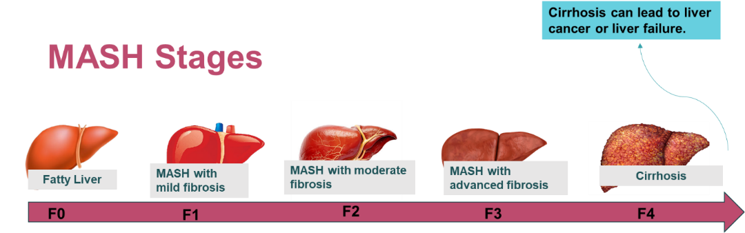 Image showing MASH disease Stages - F0 to F4